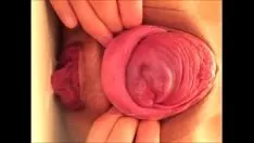 চালান জাপানি প্রোলাপসাস